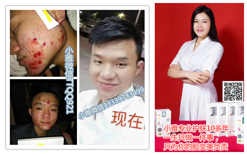 痘痘对比改善_副本2.jpg